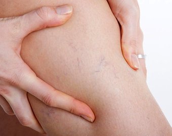 Programme of examination and treatment of patients with varicose veins of the lower extremities